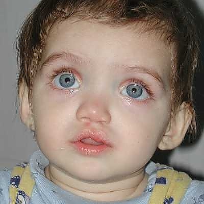 Деца с вродени цепнатини на небцето и устната и Пациенски организации 