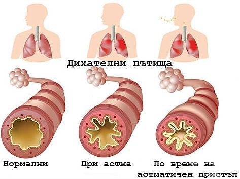 Липсва симбикорт за астма, паралелен износ
